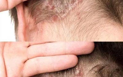 I found this on my son’s scalp. I have no idea what it is and we can’t get a doctor’s appointment right now. Do you have any advice?