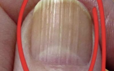 **What can vertical lines on your nails reveal about aging?**
