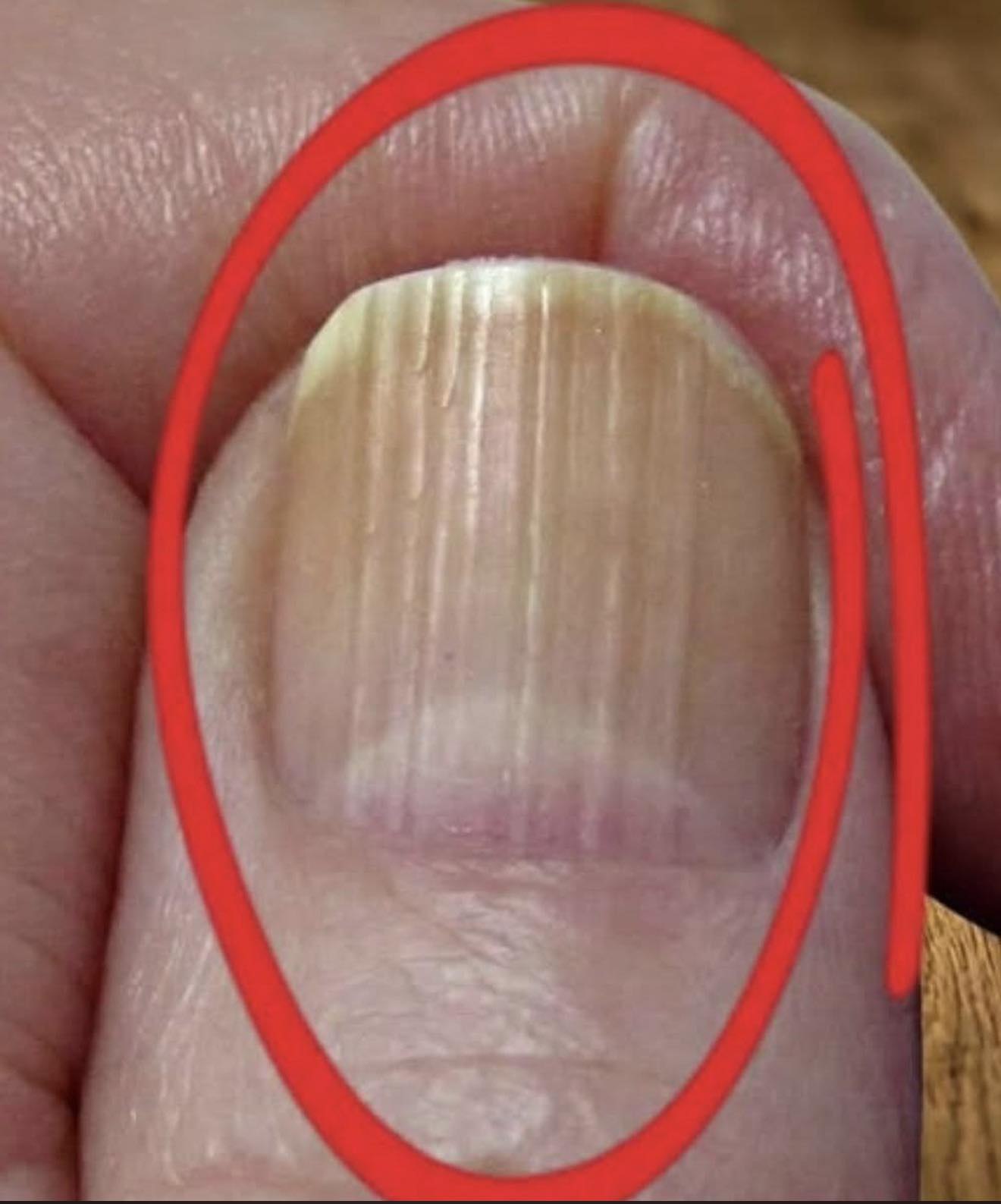 **What can vertical lines on your nails reveal about aging?**