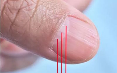 Doctor Uncovers A Telltale Sign In Your Fingernails That May Predict Your Life Expectancy