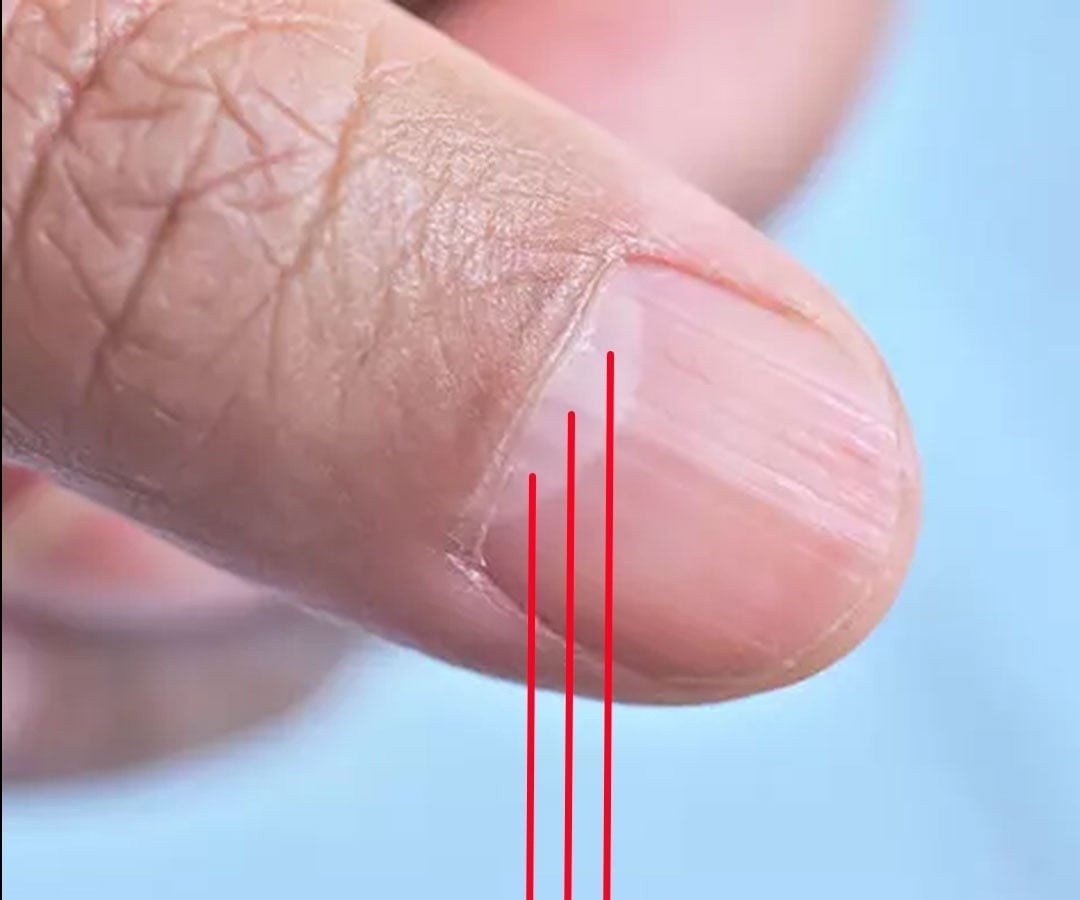 Doctor Uncovers A Telltale Sign In Your Fingernails That May Predict Your Life Expectancy