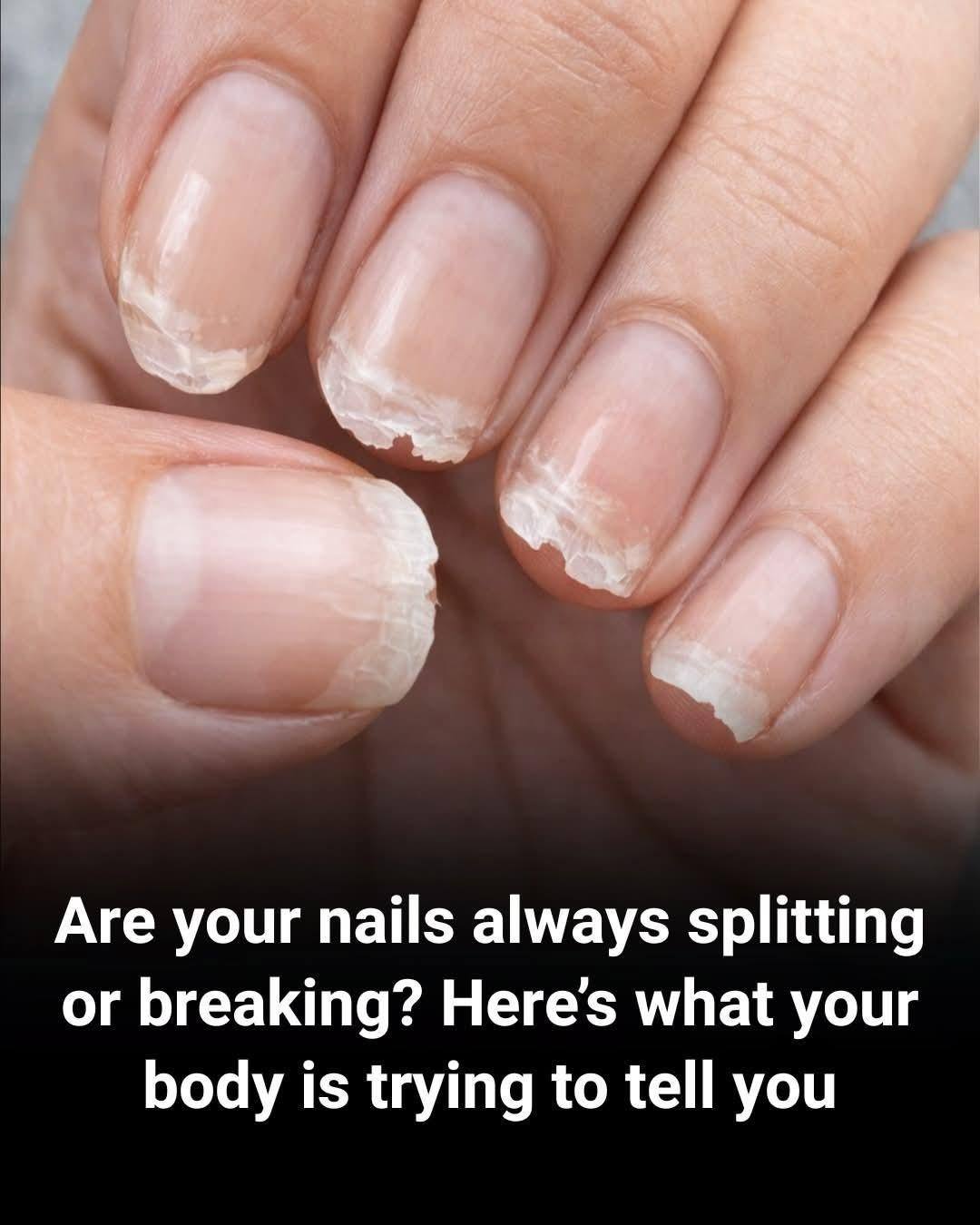Brittle or fragile nails: what your body is trying to tell you
