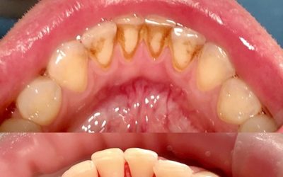 Home remedies to remove tartar from teeth