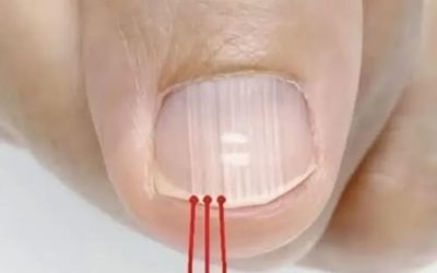 If you have these lines on your nails after 40, it is a clear sign that..