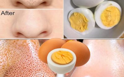 Say Goodbye to Blackheads with Just One Egg – Here’s How!